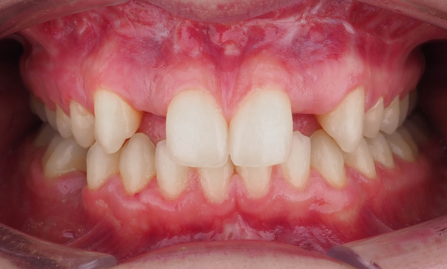 Implantes en Incisivos laterales – antes
